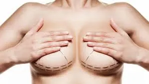 Mamoplastia redutora